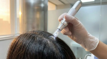 Microagulhamento Capilar – Drª Thaís Gobbo Dermatologista