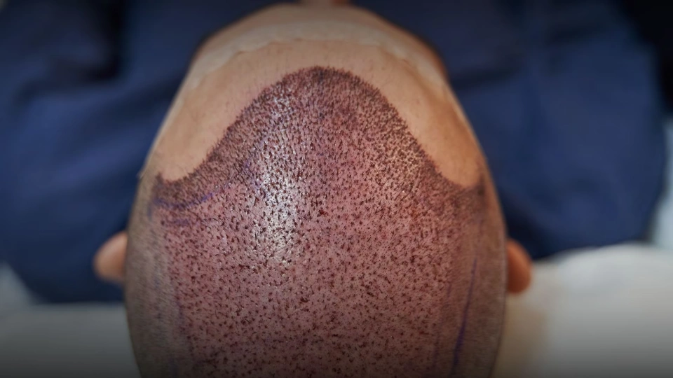 Transplante Capilar (FUE) – Drª Thaís Gobbo Dermatologista